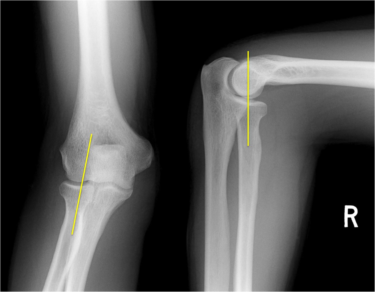 Elbow X Ray Anatomy Anatomical Charts & Posters